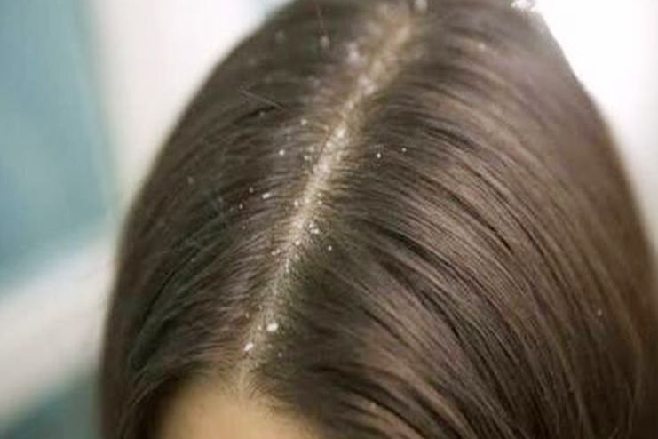 Removes dandruff and treats dry scalp