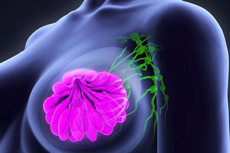 Aluminium and breast cancer