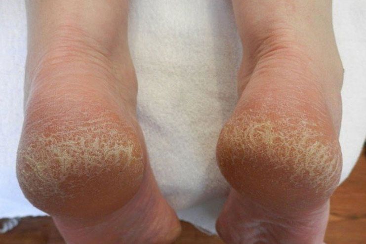 Dry and cracked feet