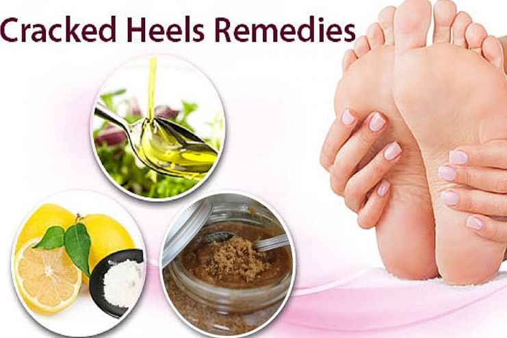 Home remedies for cracked feet