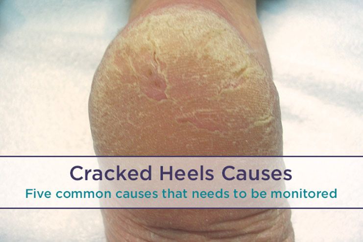 What causes cracked heels