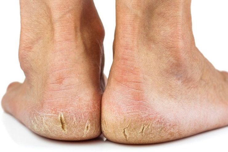 What are the symptoms of cracked heels