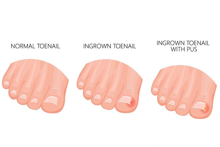 What is an ingrown toenail
