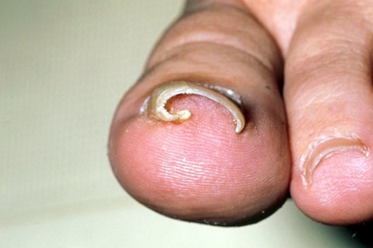 What causes ingrown toenail