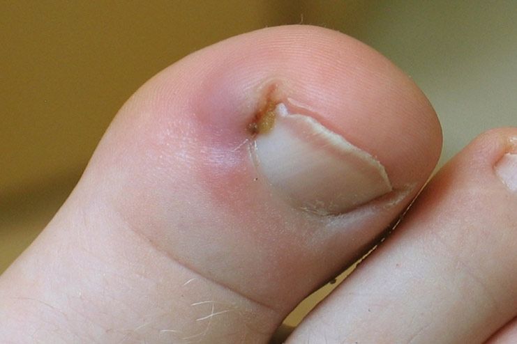 What are the symptoms of ingrown toenails
