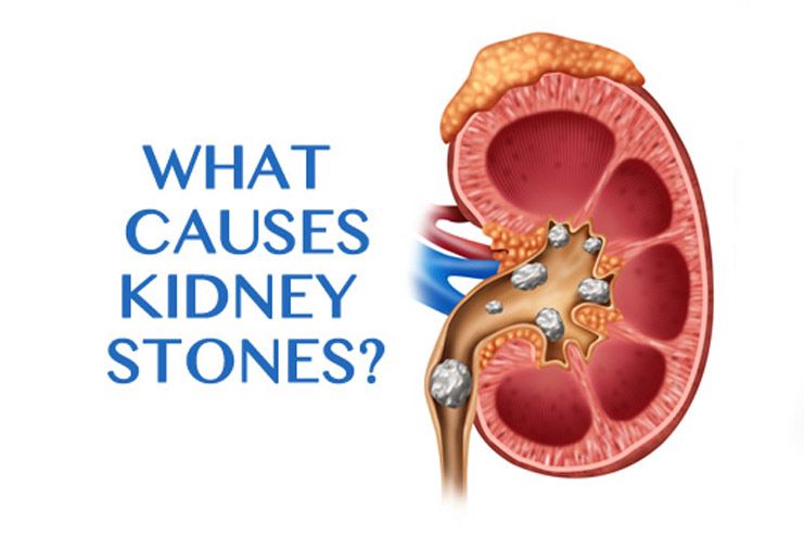 What are the causes of kidney stones