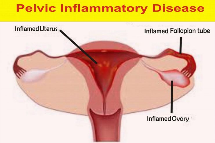 Pelvic inflammatory disease