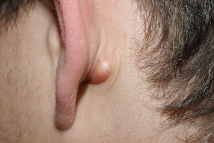 What is sebaceous cyst
