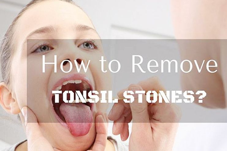 tonsil stones naturally
