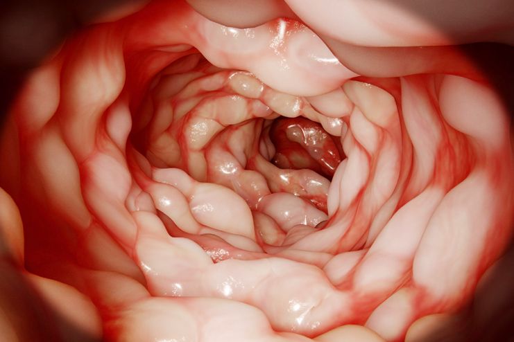 Crohn’s disease