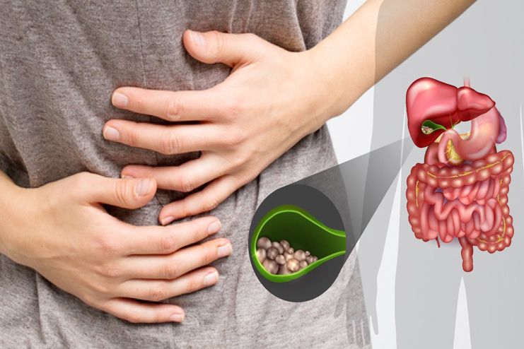 Gallstones can cause stomach pain after eating