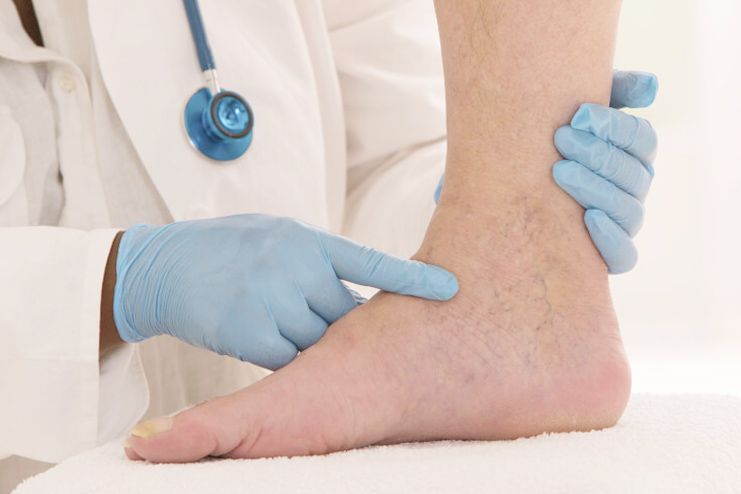 What is Poor Blood Circulation What is Poor Blood Circulation