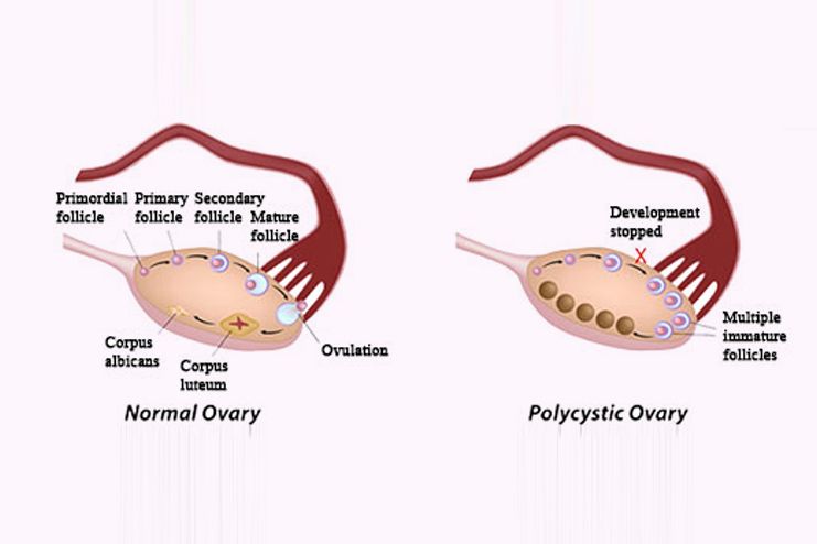 Flaxseed for PCOS