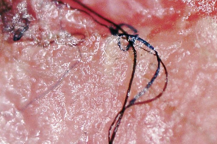 What is morgellons