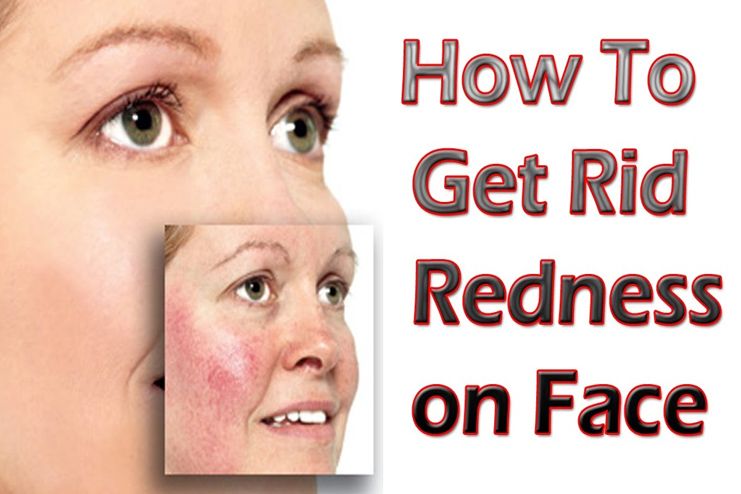 get rid of redness