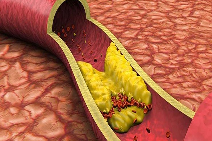 Almond Oil for Lowering Cholesterol