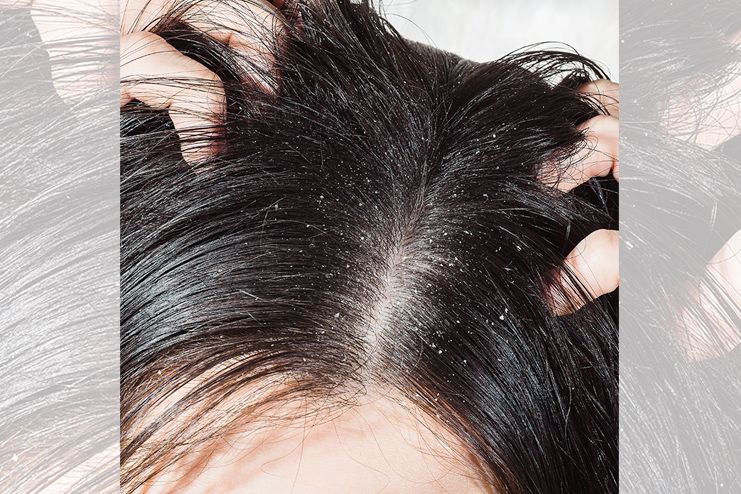 Almond Oil for Dandruff