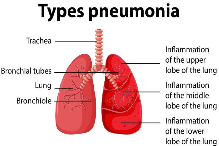 Types and Causes of Pneumonia