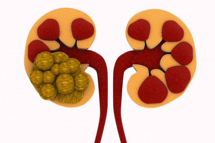 Dandelion benefits for Kidney Stones