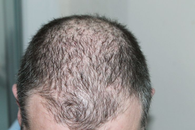 Dandelion benefits for preventing Hair Loss