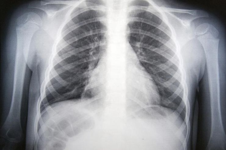 How Long Does Pneumonia Last