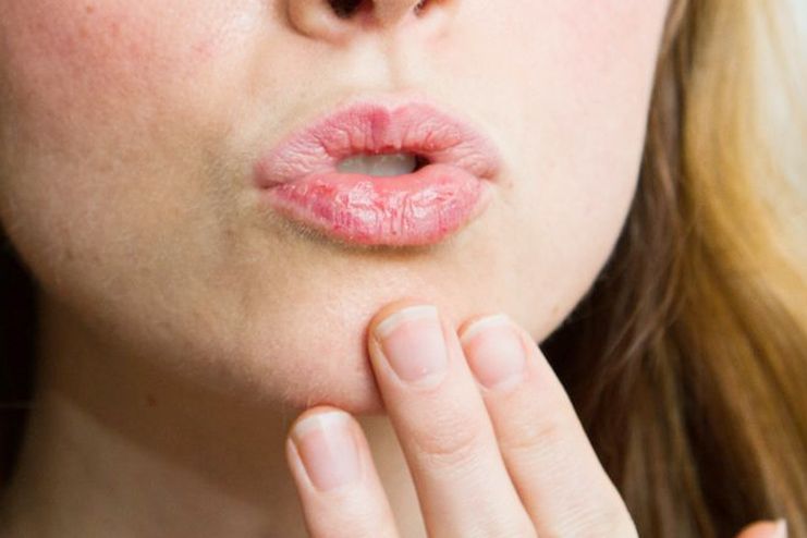 Symptoms of Chapped Lips