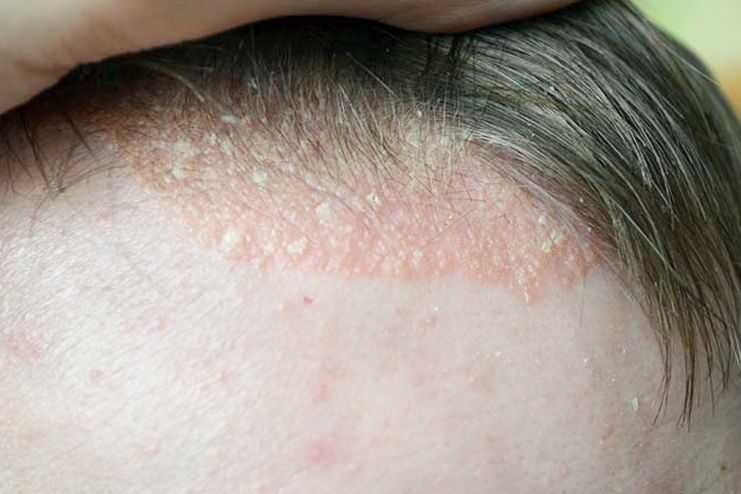 Symptoms of scabs on scalp