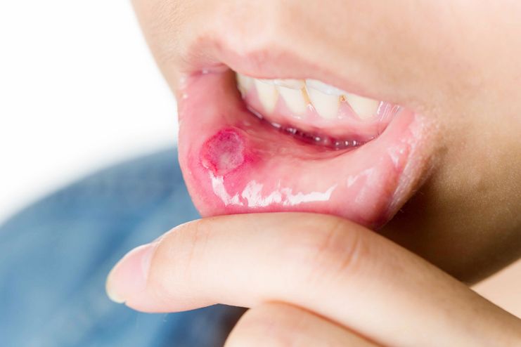 Types of Mouth Ulcers