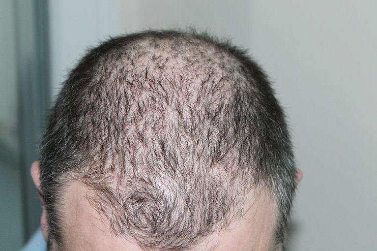 Vitamin A for Hair Loss and Hair Growth