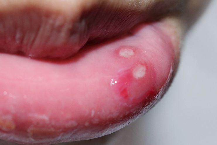 What are Mouth Ulcers