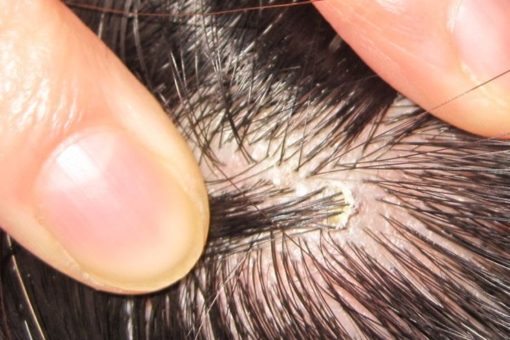 What are scabs on scalp