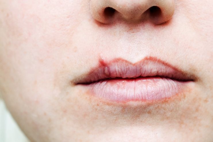 What causes chapped lips