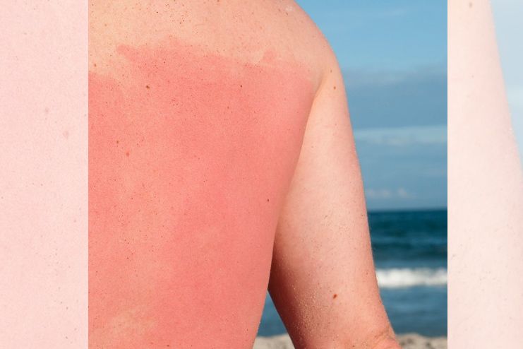 Benefits of tomatoes for Sunburn