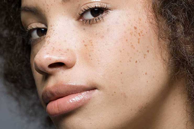 Types of Freckles