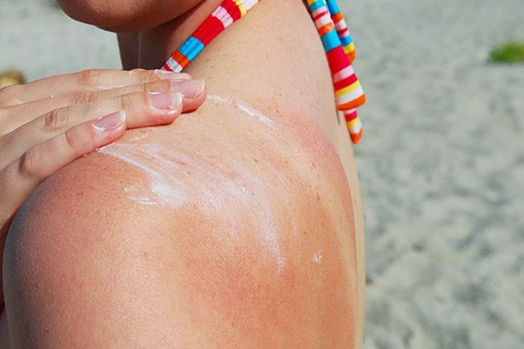 Vitamin C Serum for Healing Sunburn