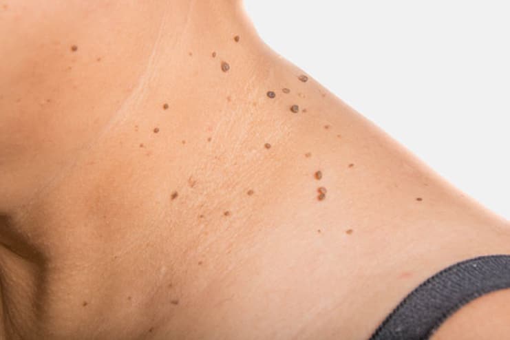 What causes skin tags