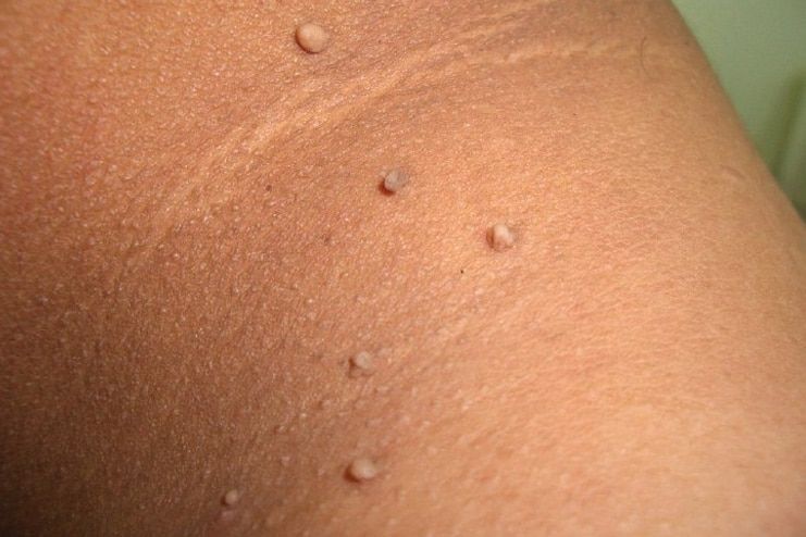 How to identify a skin tag