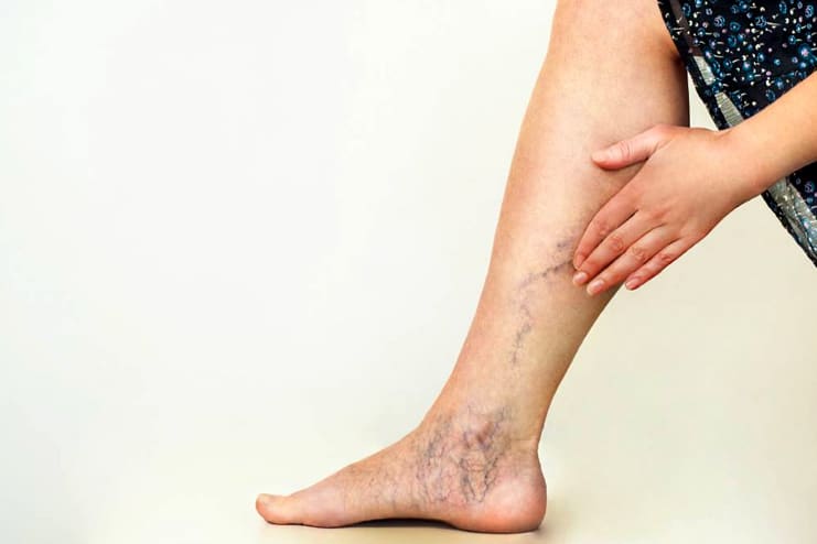 What are Varicose Veins