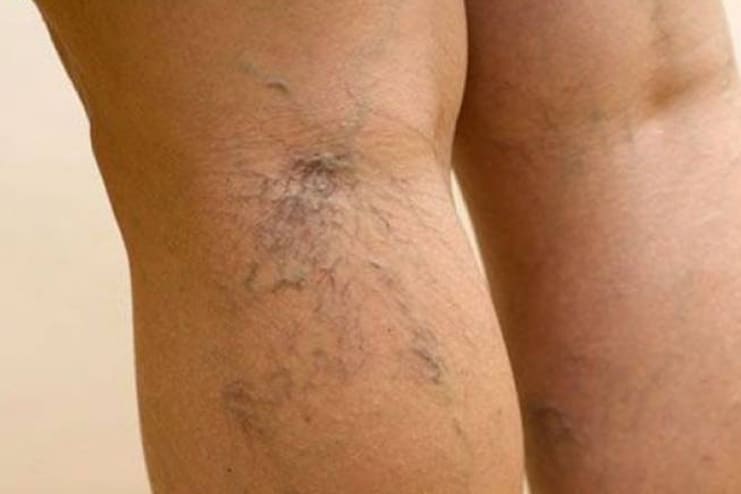 How to get rid of Varicose Veins