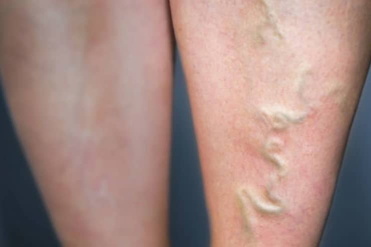 Risk factors of Varicose Veins