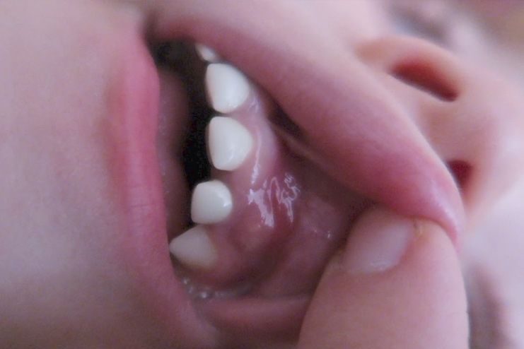What is an abscess tooth