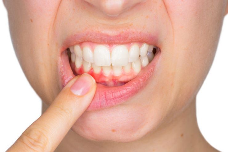 What causes abscess tooth