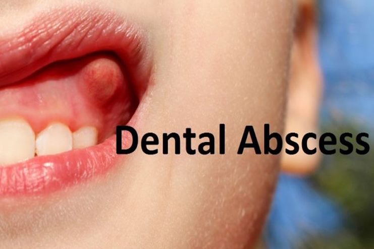 Symptoms Of Abscess Tooth