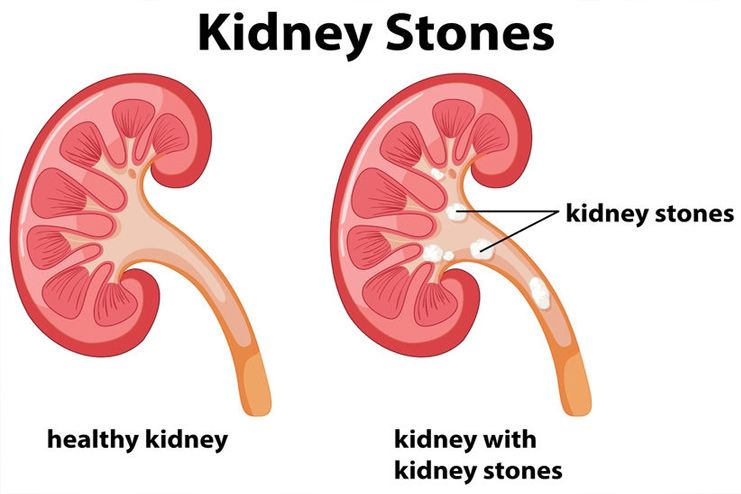 Lowers risk of developing kidney stones