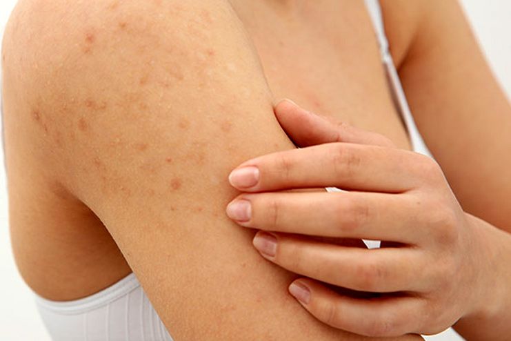 Symptoms of Keratosis Pilaris