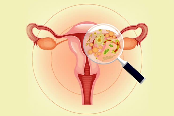 What is Bacterial Vaginosis