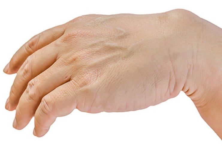 How to prevent Ganglion Cyst