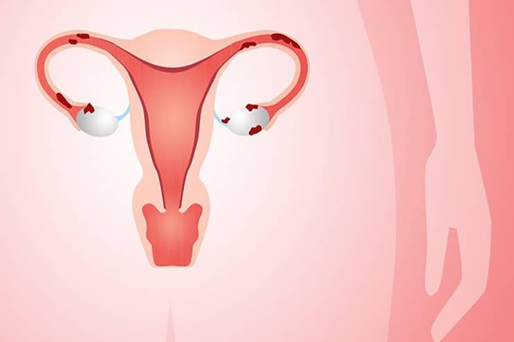 What Causes Endometriosis