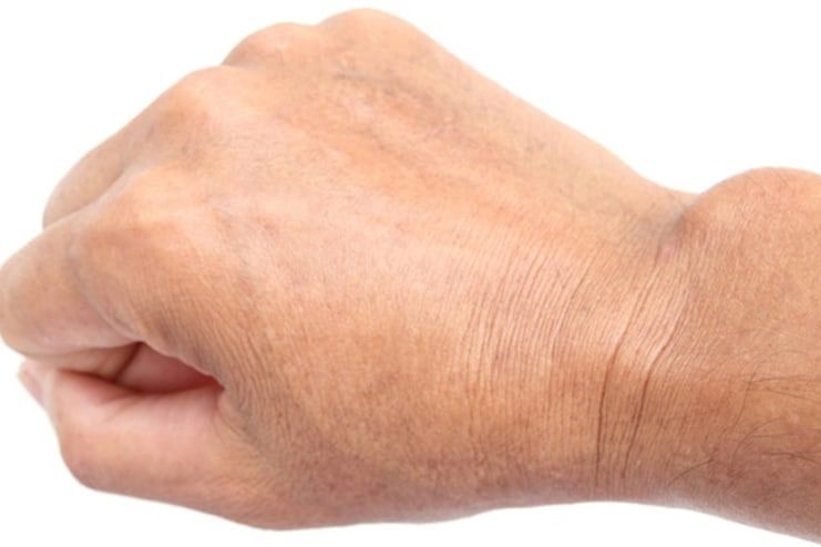 What Causes Ganglion Cyst