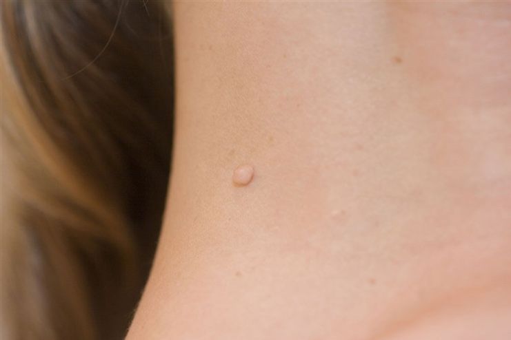 What are skin tags
